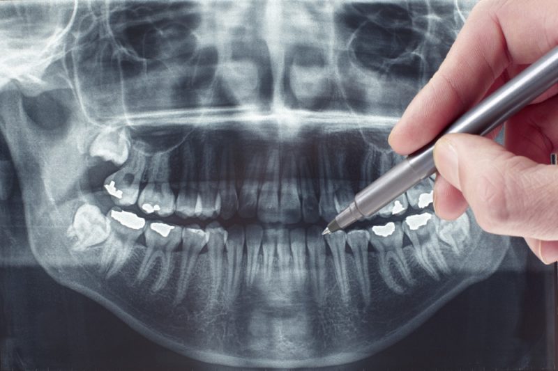 Post Endo Restorations and Microleakage - Endodontic Associates